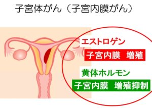 Pms ミレーナ